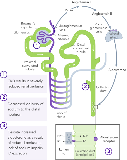 Diagram: reduced renal perfusion results in impaired K+ excretion