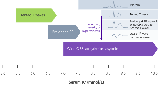 Progressive ECG changes with increasing severity of hyperkalaemia